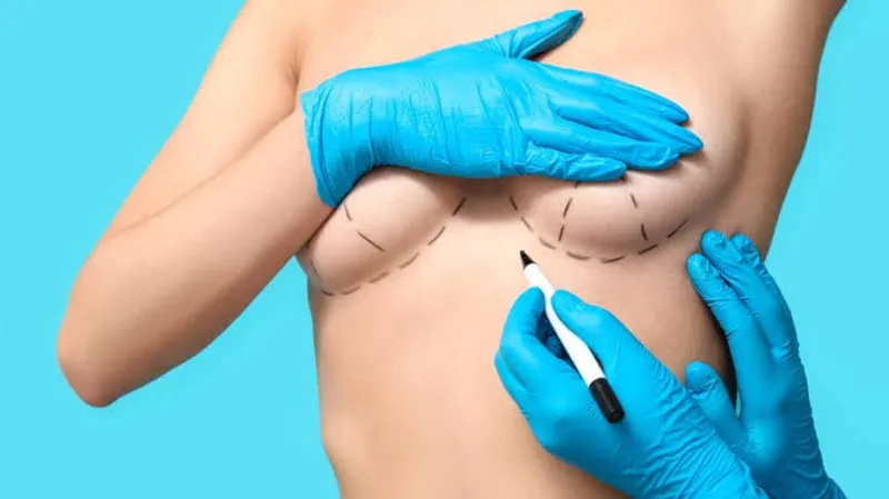 Como aumenta tu autoestima el aumento de pechos con mamoplastia